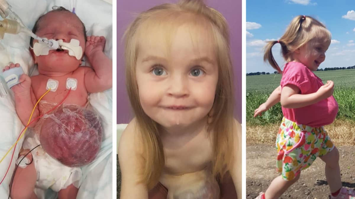 Two-Year-Old Toddler Born With Organs Outside Her Body Defies Odds ...